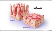 سلیاک، بیماری خاموش با علائم گوارشی