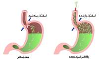 هرآنچه که باید درباره رفلاکس معده بدانید