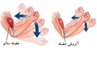 وجود 3 بیمار مبتلا به آتروفی عضلانی نخاعی در استان